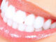 Teeth Whitening | Cannon Hill Smiles
