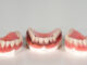 Mouthguards | Cannon Hill Smiles