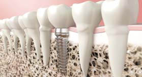 Dental Implants | Cannon Hill Smiles