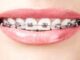 Braces | Cannon Hill Smiles