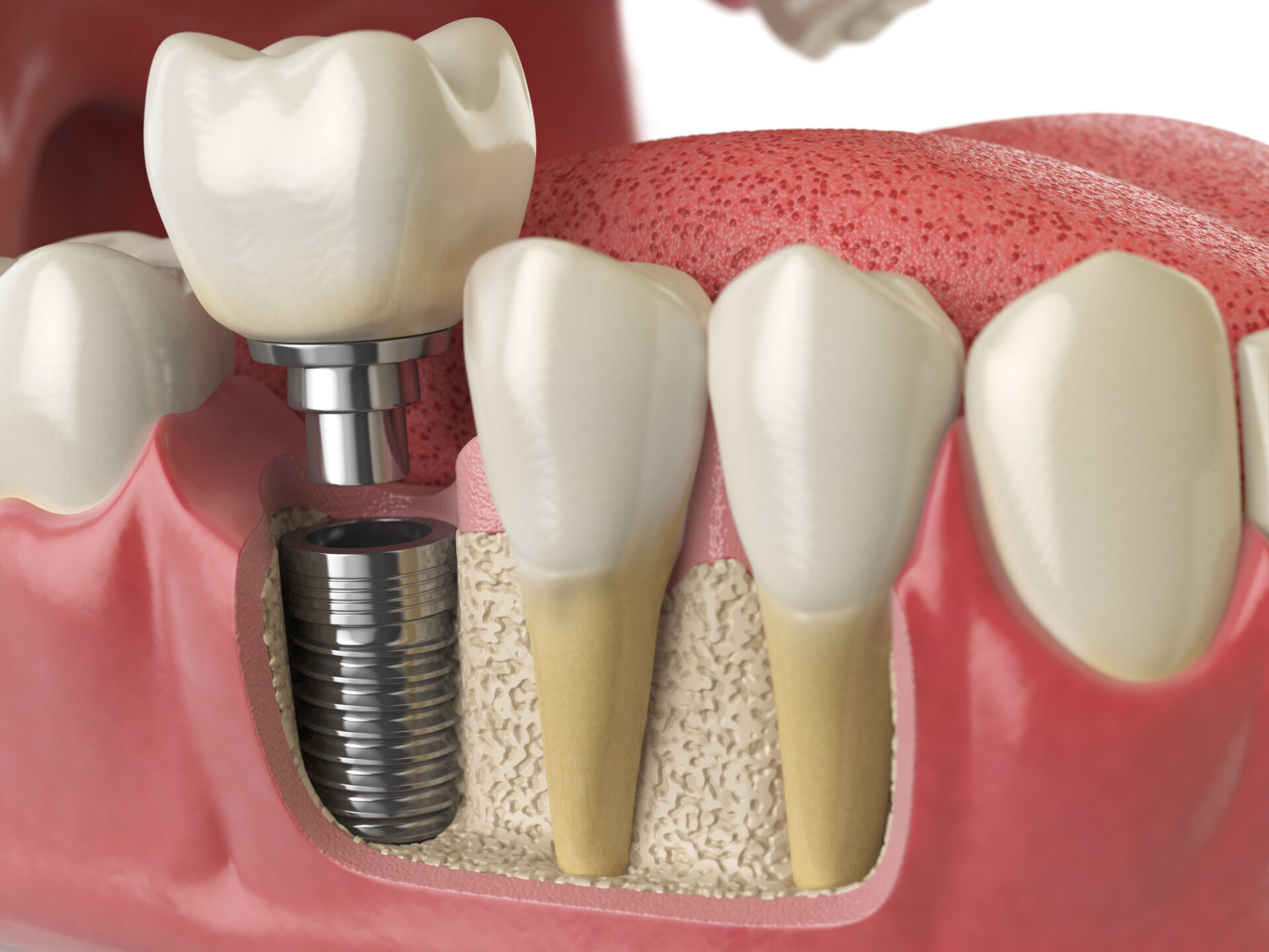 dental implant procedure in cannon hill with implant dentist brisbane