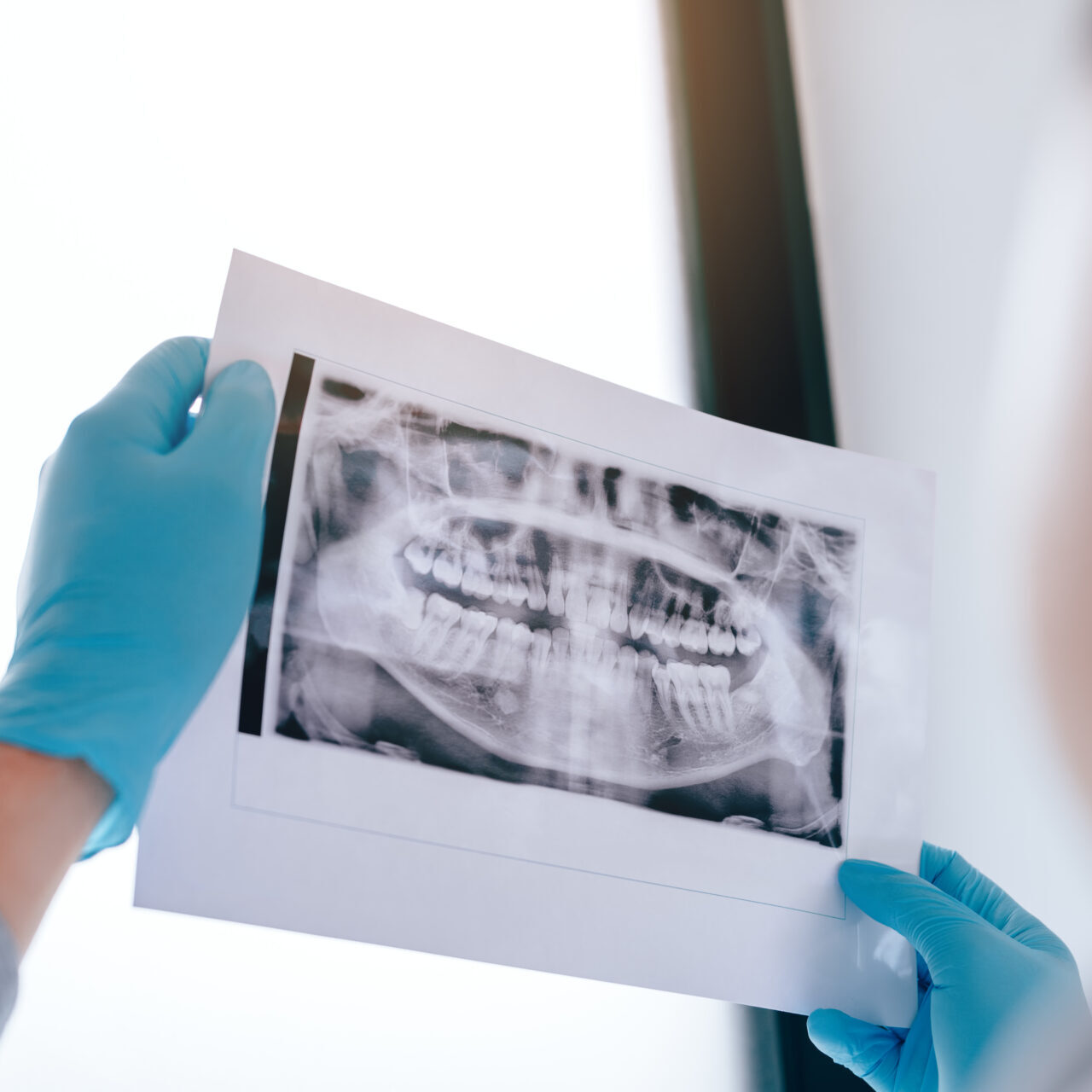 wisdom teeth removal in brisbane with a cannon hill dentist