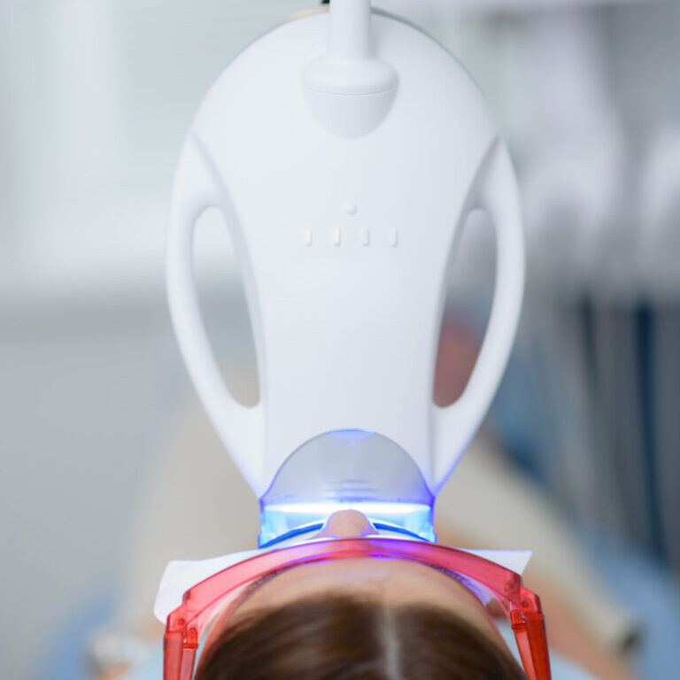 teeth whitening in cannon hill - dentist in-chair teeth whitening brisbane